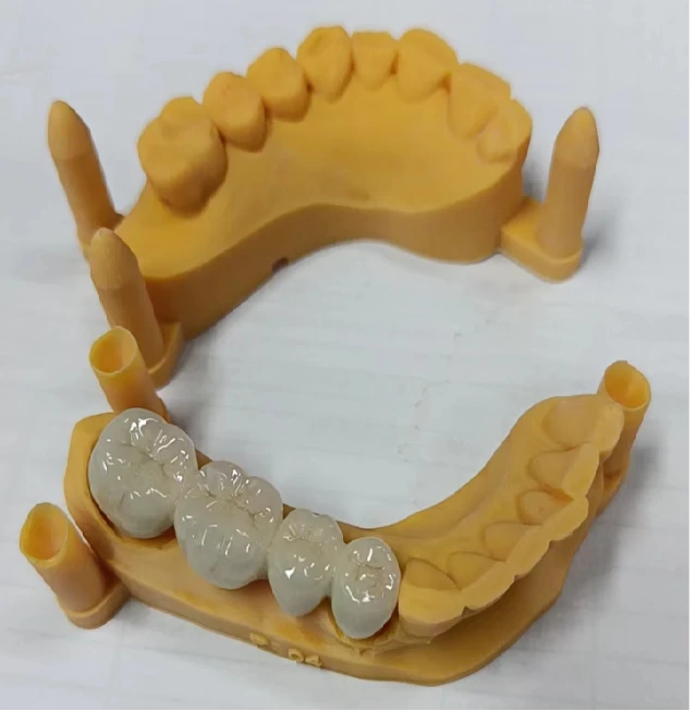 Высококачественный PFM COCR Dental Bridge